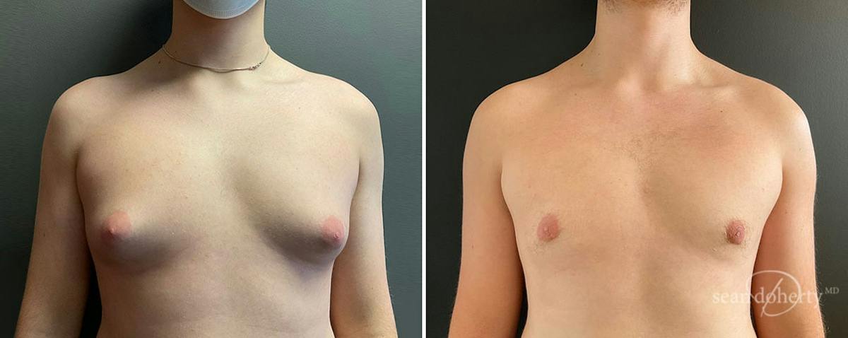 Male Breast Reduction (Gynecomastia) Before & After Gallery - Patient 173648 - Image 1