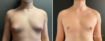 Male Breast Reduction (Gynecomastia) Before & After Gallery - Patient 173648 - Image 1