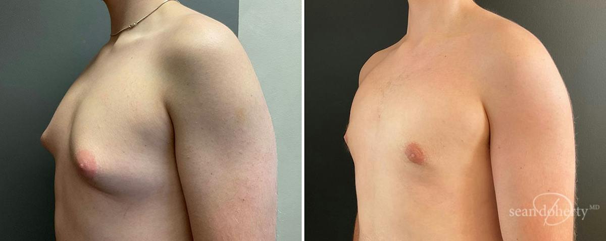 Male Breast Reduction (Gynecomastia) Before & After Gallery - Patient 173648 - Image 2