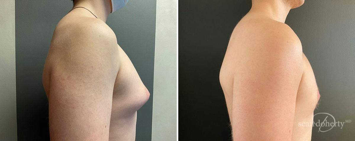 Male Breast Reduction (Gynecomastia) Before & After Gallery - Patient 173648 - Image 3