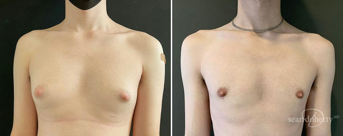 Male Breast Reduction (Gynecomastia) Before & After Gallery - Patient 307764 - Image 1