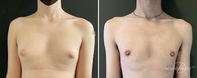 Male Breast Reduction (Gynecomastia) Before & After Gallery - Patient 307764 - Image 1