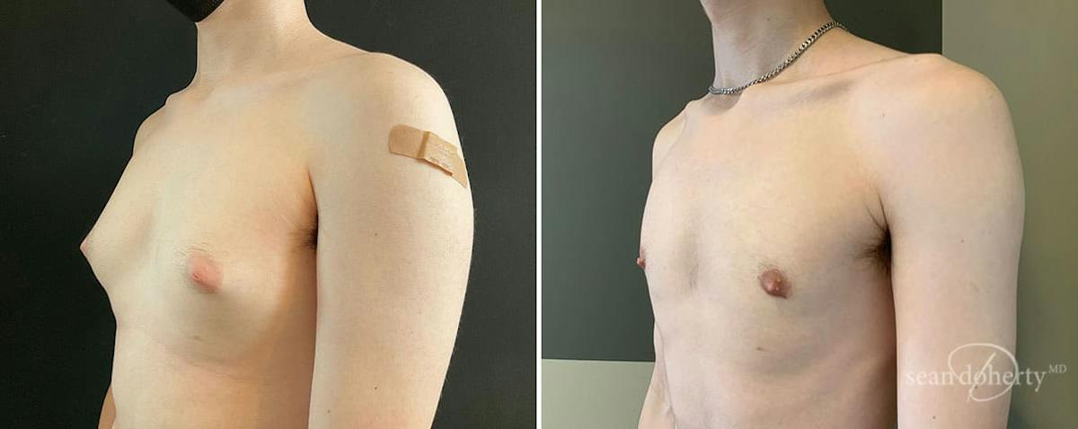 Male Breast Reduction (Gynecomastia) Before & After Gallery - Patient 307764 - Image 2