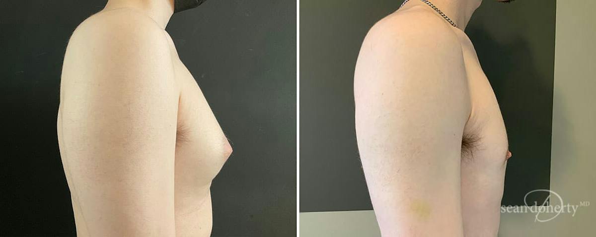 Male Breast Reduction (Gynecomastia) Before & After Gallery - Patient 307764 - Image 3