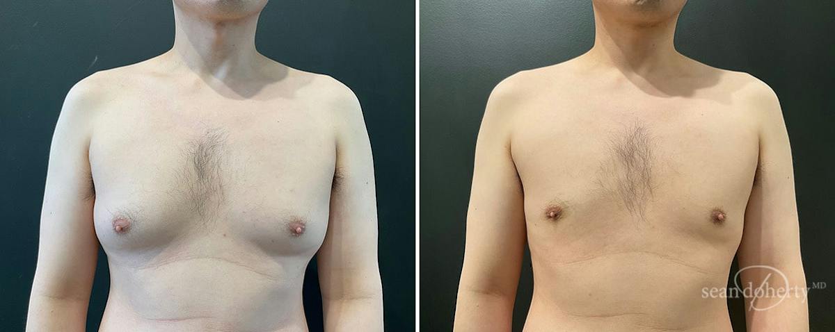 Male Breast Reduction (Gynecomastia) Before & After Gallery - Patient 358555 - Image 1