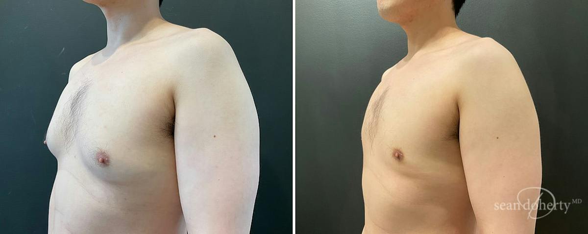 Male Breast Reduction (Gynecomastia) Before & After Gallery - Patient 358555 - Image 2