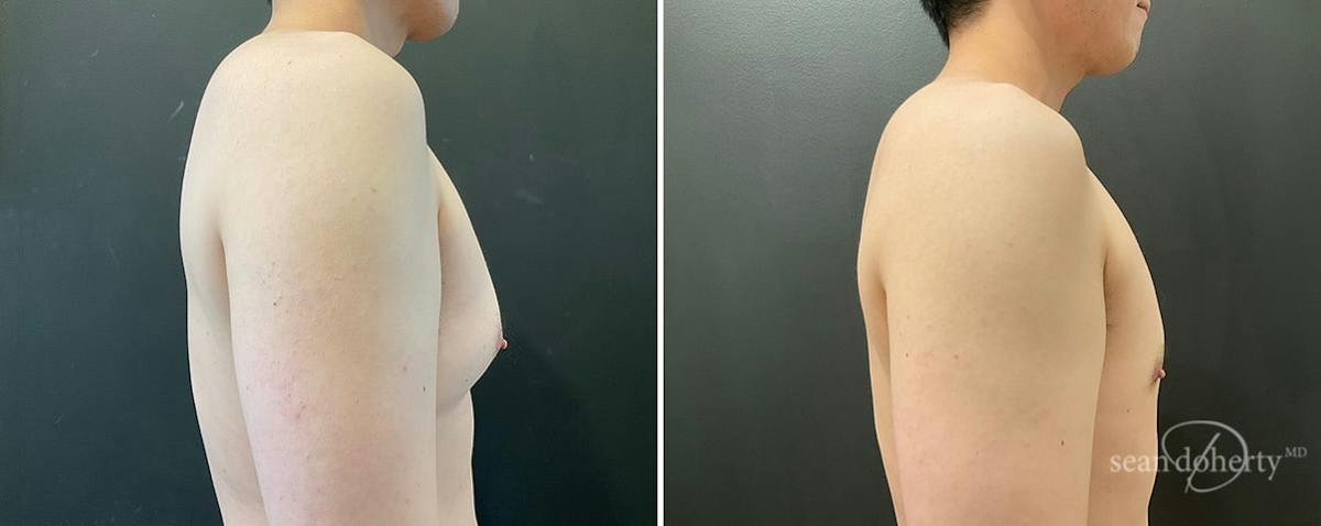 Male Breast Reduction (Gynecomastia) Before & After Gallery - Patient 358555 - Image 3