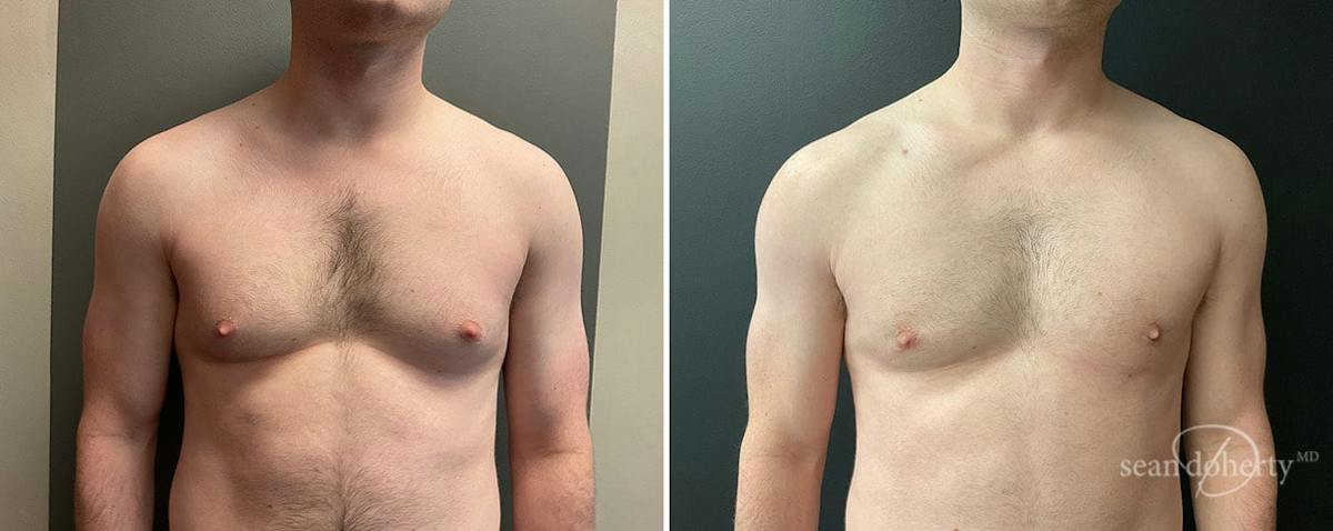 Male Breast Reduction (Gynecomastia) Before & After Gallery - Patient 281719 - Image 1