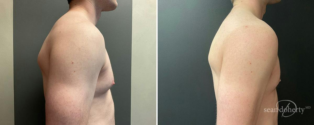 Male Breast Reduction (Gynecomastia) Before & After Gallery - Patient 281719 - Image 3