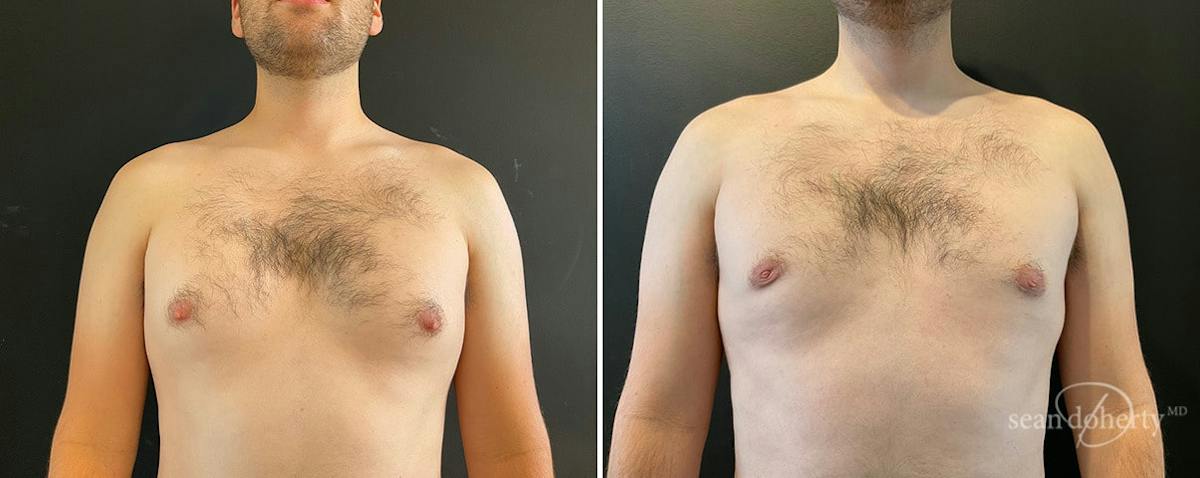 Male Breast Reduction (Gynecomastia) Before & After Gallery - Patient 289543 - Image 1