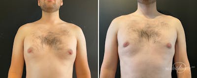 Male Breast Reduction (Gynecomastia) Before & After Gallery - Patient 289543 - Image 1