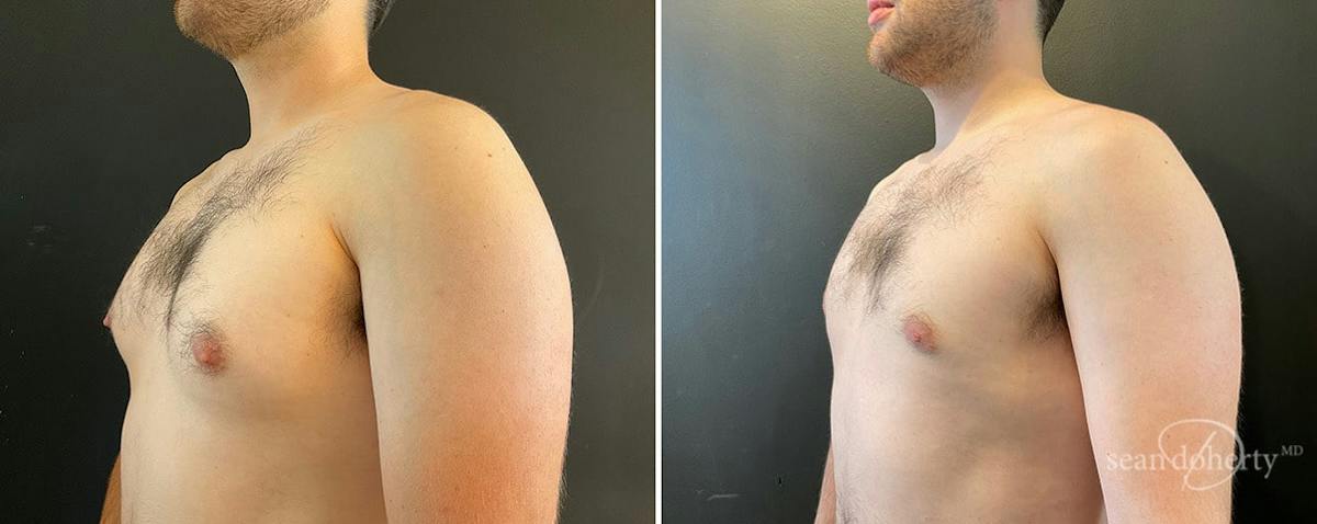 Male Breast Reduction (Gynecomastia) Before & After Gallery - Patient 289543 - Image 2