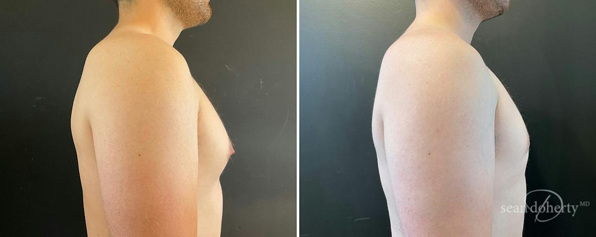 Male Breast Reduction (Gynecomastia) Before & After Gallery - Patient 289543 - Image 3
