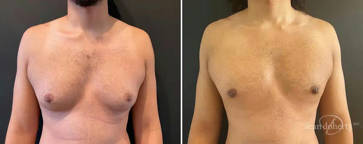 Male Breast Reduction (Gynecomastia) Before & After Gallery - Patient 424133 - Image 1