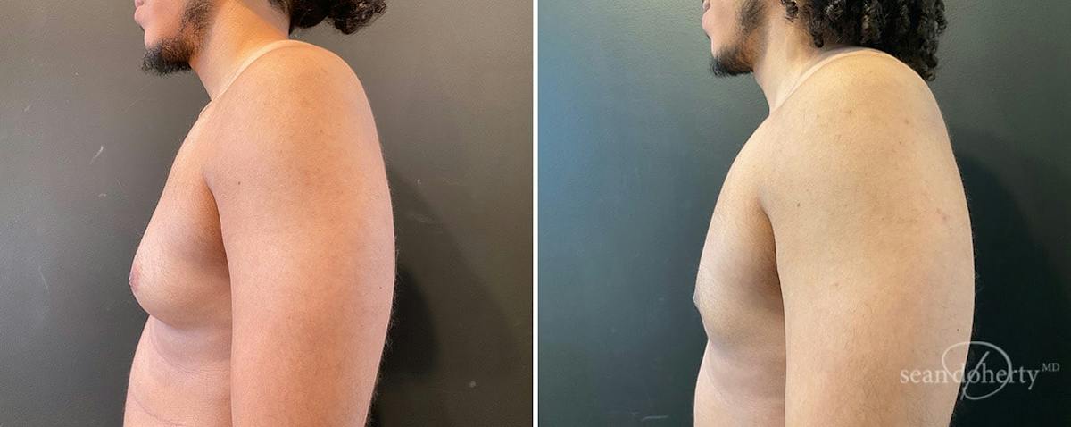 Male Breast Reduction (Gynecomastia) Before & After Gallery - Patient 424133 - Image 3