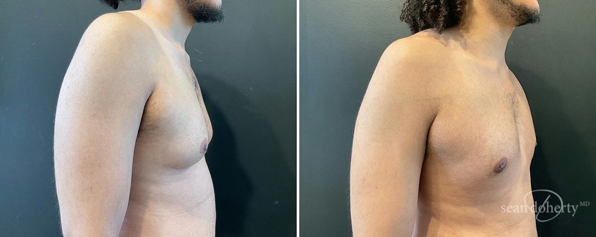 Male Breast Reduction (Gynecomastia) Before & After Gallery - Patient 424133 - Image 2
