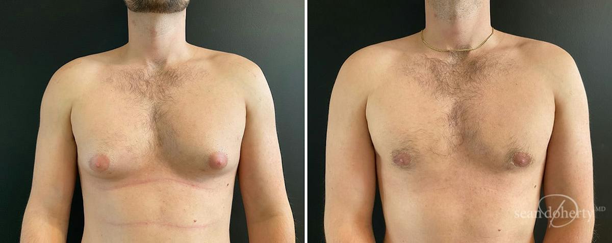 Male Breast Reduction (Gynecomastia) Before & After Gallery - Patient 133864 - Image 1