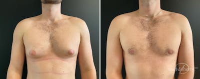 Male Breast Reduction (Gynecomastia) Before & After Gallery - Patient 133864 - Image 1