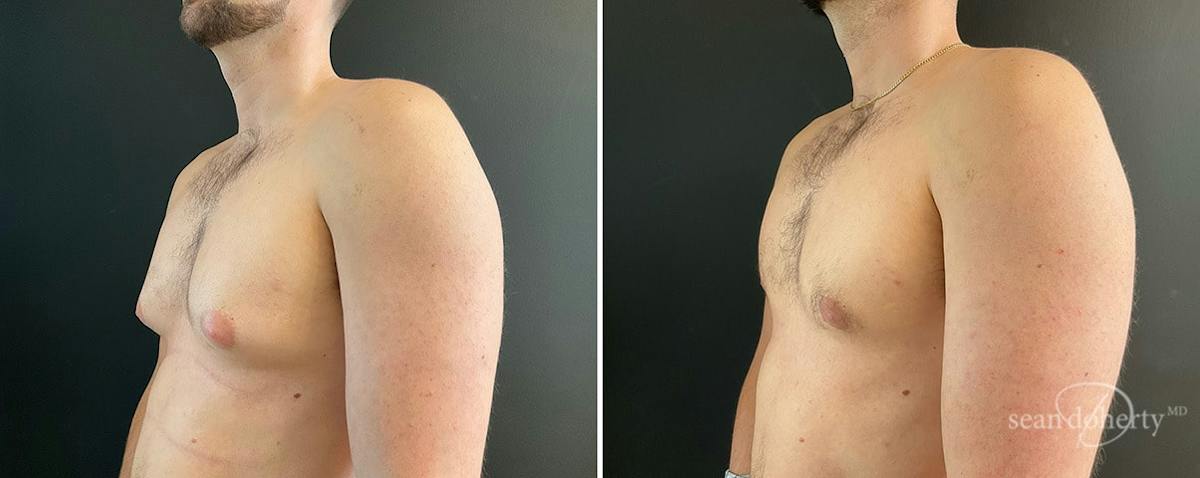 Male Breast Reduction (Gynecomastia) Before & After Gallery - Patient 133864 - Image 3
