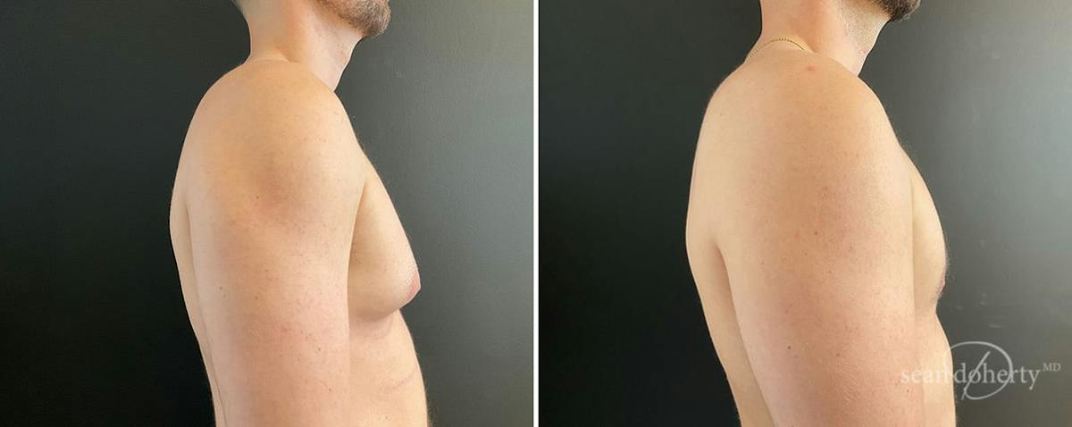 Male Breast Reduction (Gynecomastia) Before & After Gallery - Patient 133864 - Image 2