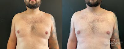 Male Breast Reduction (Gynecomastia) Before & After Gallery - Patient 408815 - Image 1