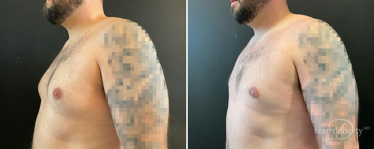 Male Breast Reduction (Gynecomastia) Before & After Gallery - Patient 408815 - Image 2