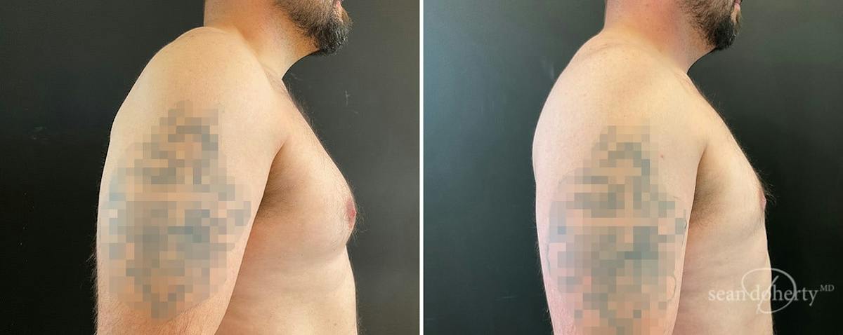 Male Breast Reduction (Gynecomastia) Before & After Gallery - Patient 408815 - Image 3