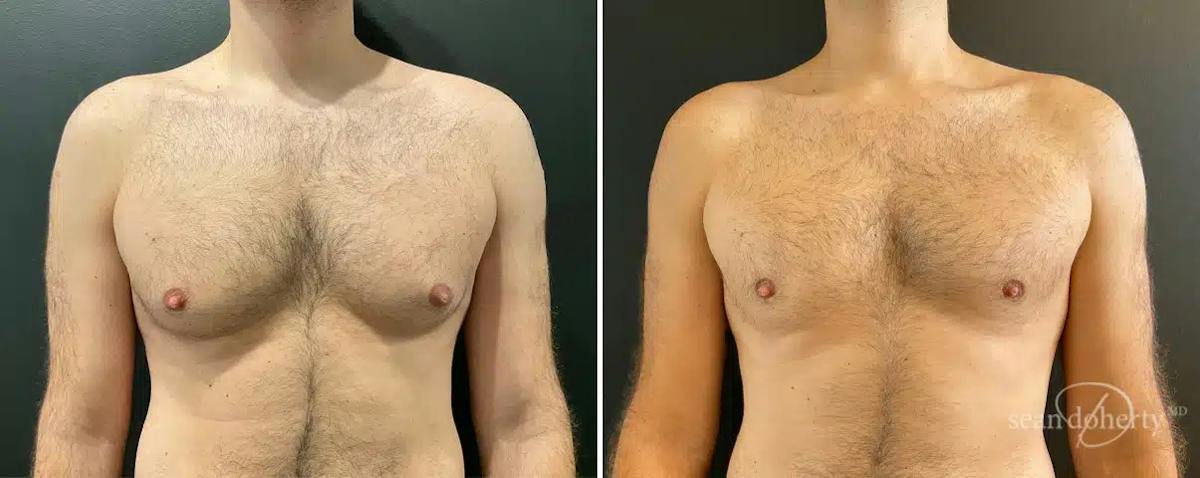 Male Breast Reduction (Gynecomastia) Before & After Gallery - Patient 121141 - Image 1