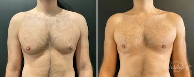 Male Breast Reduction (Gynecomastia) Before & After Gallery - Patient 121141 - Image 1