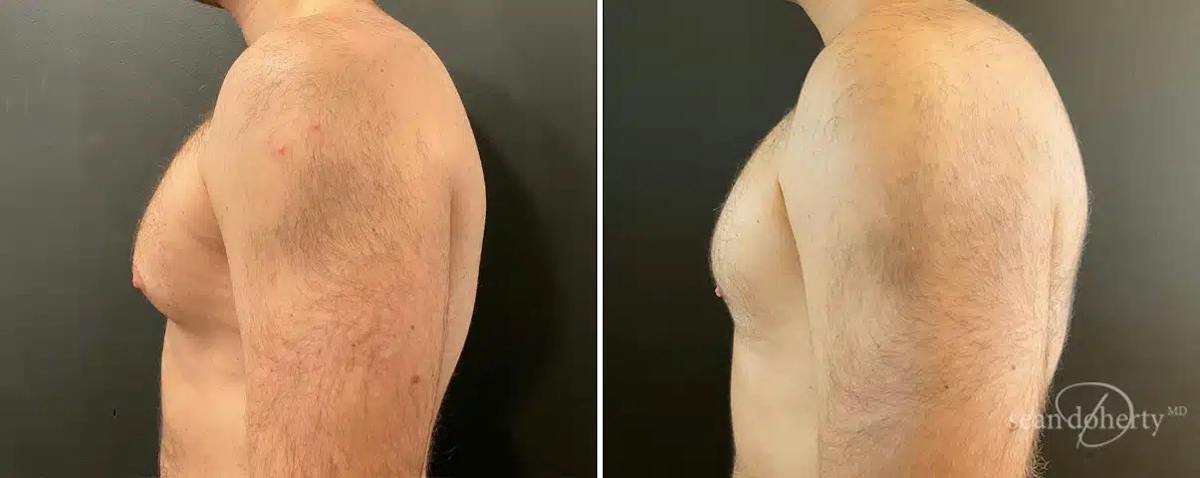 Male Breast Reduction (Gynecomastia) Before & After Gallery - Patient 121141 - Image 3