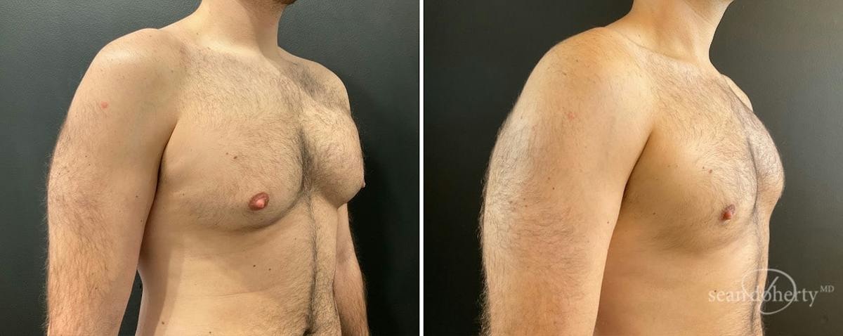 Male Breast Reduction (Gynecomastia) Before & After Gallery - Patient 121141 - Image 2