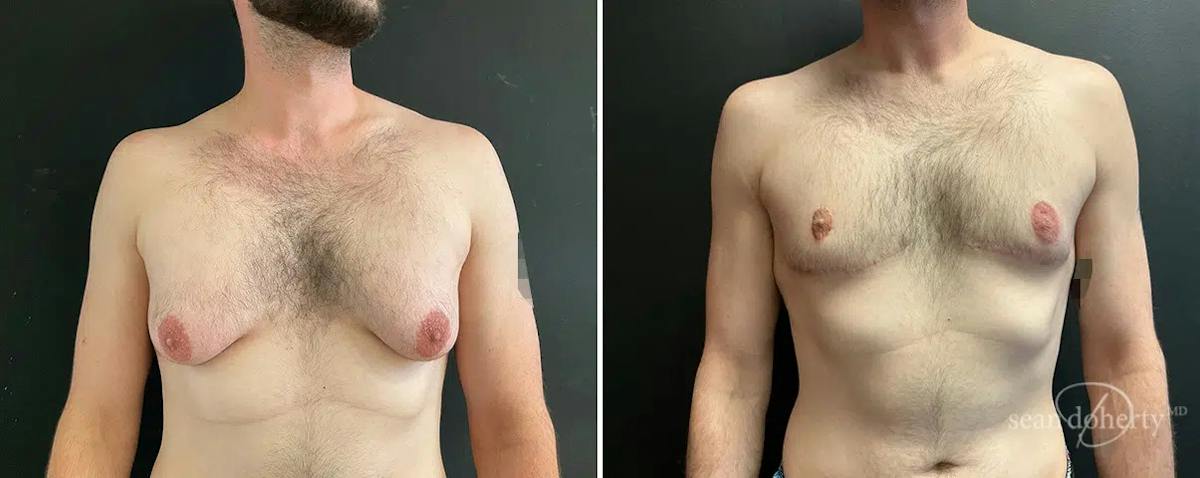 Male Breast Reduction (Gynecomastia) Before & After Gallery - Patient 367764 - Image 1