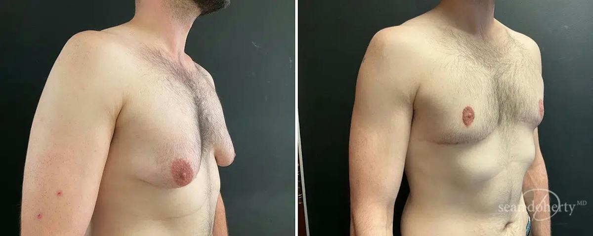 Male Breast Reduction (Gynecomastia) Before & After Gallery - Patient 367764 - Image 2