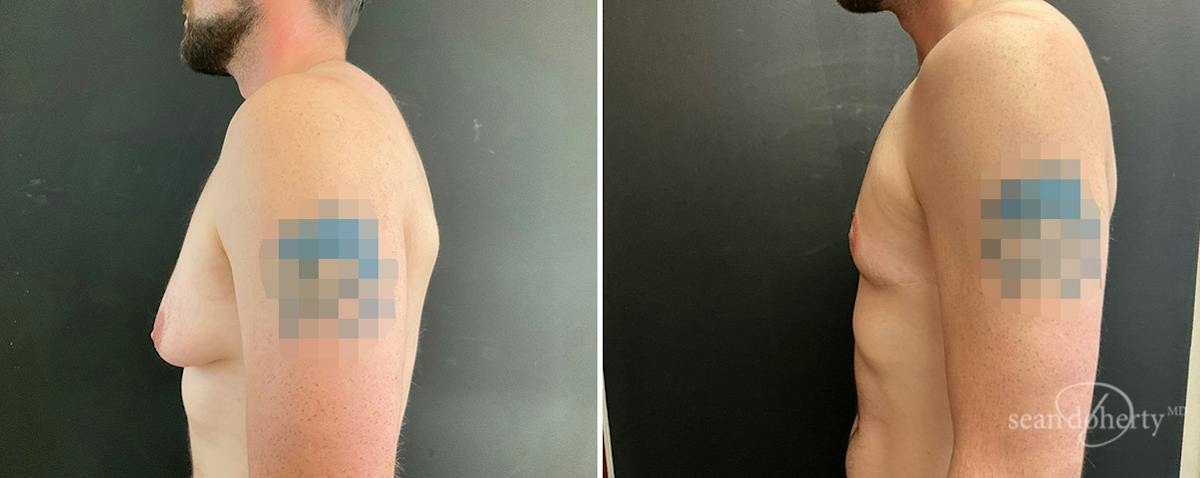 Male Breast Reduction (Gynecomastia) Before & After Gallery - Patient 367764 - Image 3