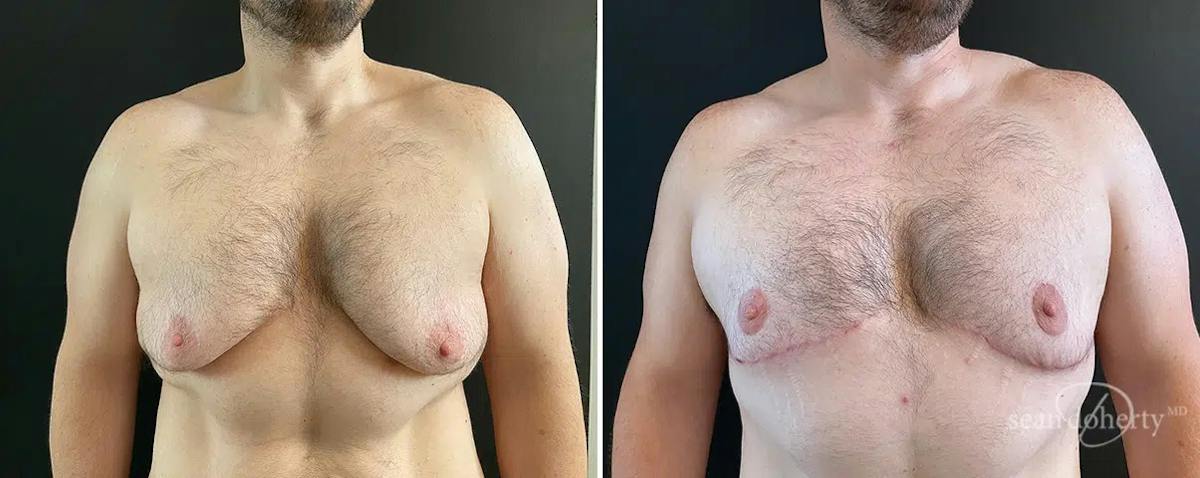 Male Breast Reduction (Gynecomastia) Before & After Gallery - Patient 387531 - Image 1
