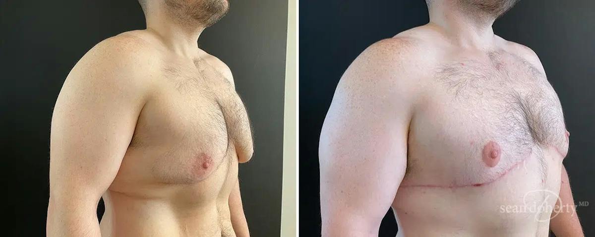 Male Breast Reduction (Gynecomastia) Before & After Gallery - Patient 387531 - Image 2