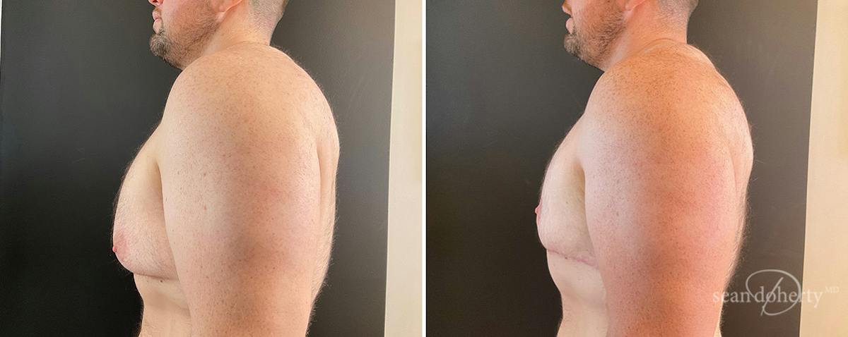 Male Breast Reduction (Gynecomastia) Before & After Gallery - Patient 387531 - Image 3