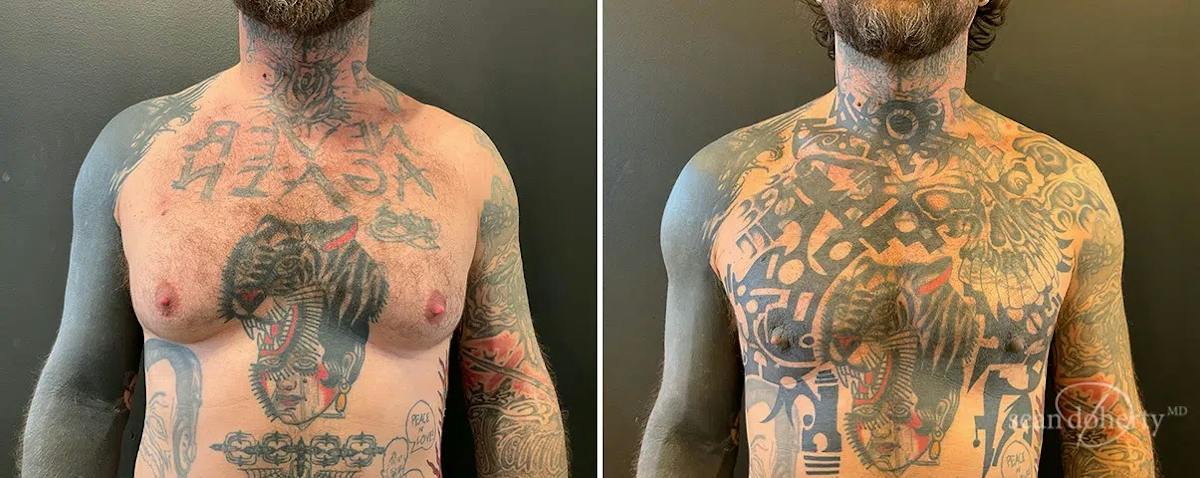 Male Breast Reduction (Gynecomastia) Before & After Gallery - Patient 115826 - Image 1