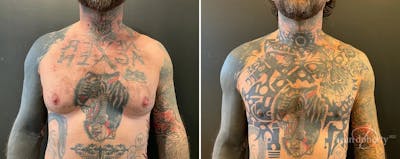 Male Breast Reduction (Gynecomastia) Before & After Gallery - Patient 115826 - Image 1