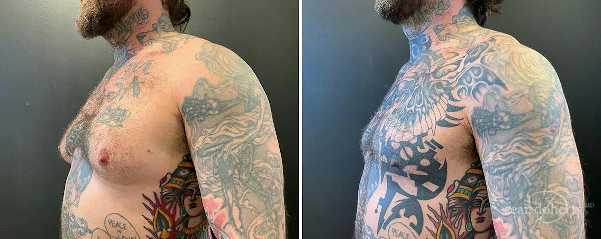 Male Breast Reduction (Gynecomastia) Before & After Gallery - Patient 115826 - Image 2