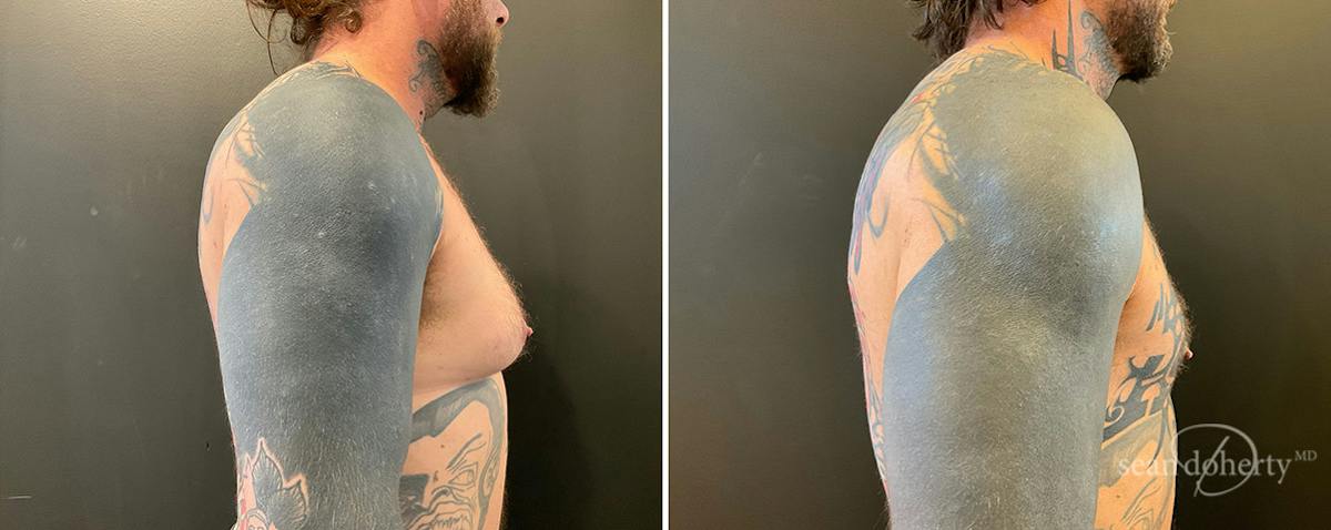 Male Breast Reduction (Gynecomastia) Before & After Gallery - Patient 115826 - Image 3