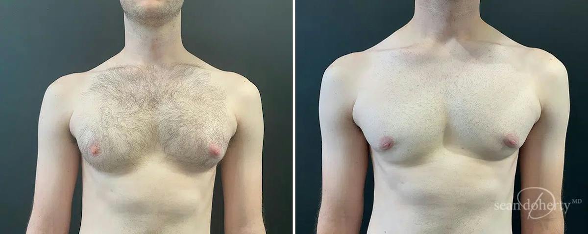 Male Breast Reduction (Gynecomastia) Before & After Gallery - Patient 334704 - Image 1