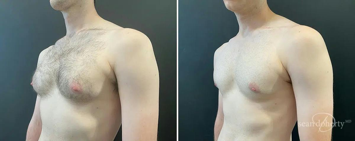 Male Breast Reduction (Gynecomastia) Before & After Gallery - Patient 334704 - Image 2