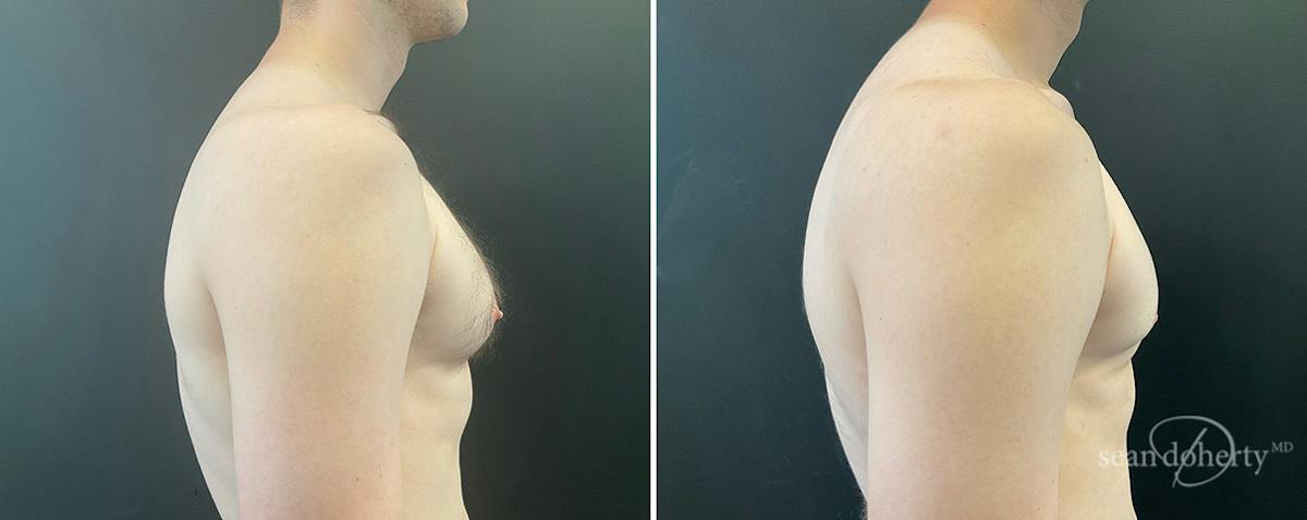 Male Breast Reduction (Gynecomastia) Before & After Gallery - Patient 334704 - Image 3