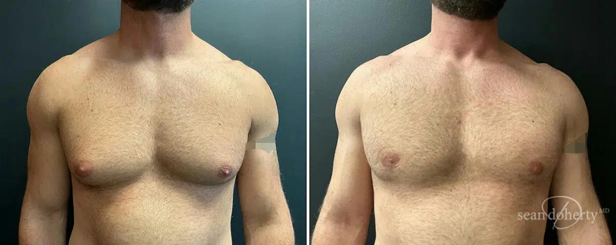 Male Breast Reduction (Gynecomastia) Before & After Gallery - Patient 395275 - Image 1