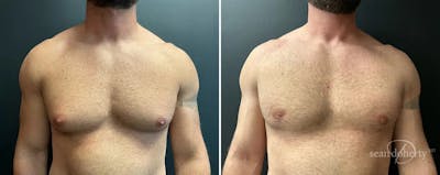 Male Breast Reduction (Gynecomastia) Before & After Gallery - Patient 395275 - Image 1