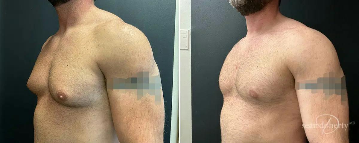 Male Breast Reduction (Gynecomastia) Before & After Gallery - Patient 395275 - Image 2
