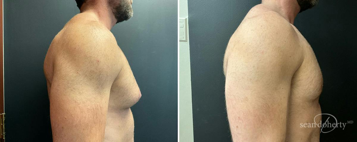 Male Breast Reduction (Gynecomastia) Before & After Gallery - Patient 395275 - Image 3