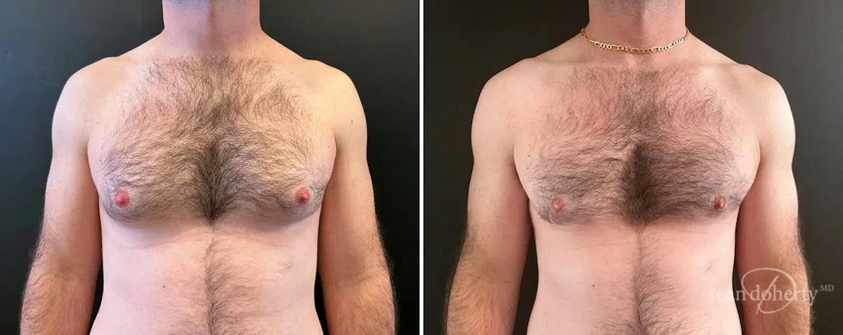 Male Breast Reduction (Gynecomastia) Before & After Gallery - Patient 149162 - Image 1