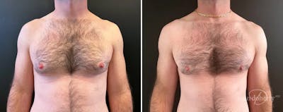 Male Breast Reduction (Gynecomastia) Before & After Gallery - Patient 149162 - Image 1